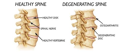 Cervical Degenerative Disc Disease Cddd Physical Therapy