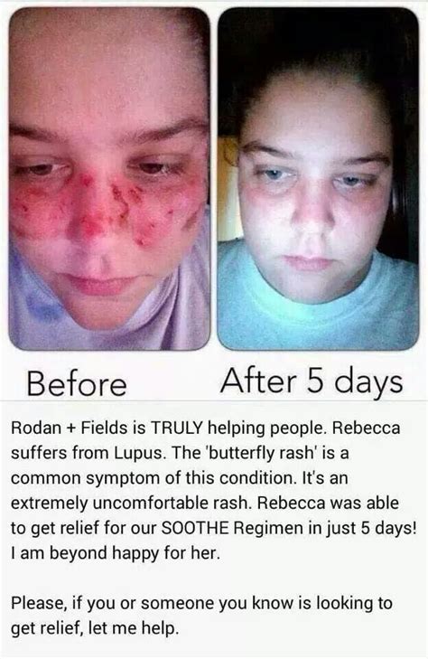 Butterfly Rash From Lupus Before And After Soothe Regimen Rodan And