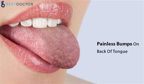 blisters on back of tongue wholesale store save 44 jlcatj gob mx