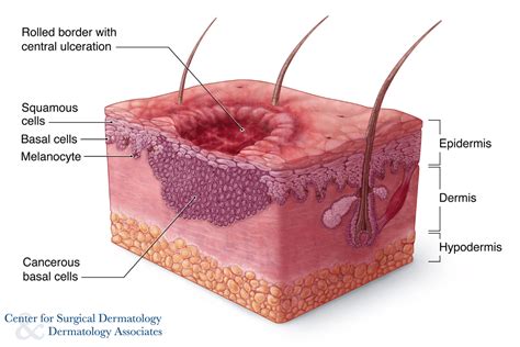 Identifying The Types Of Basal Cell Carcinoma Center For Surgical Dermatology