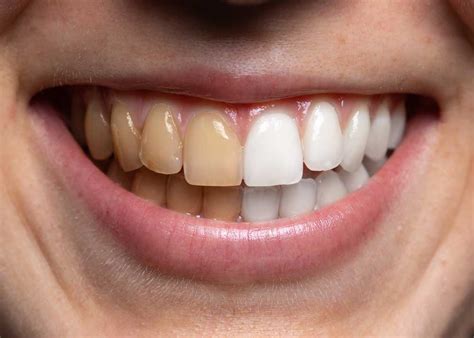 Besides the use of tobacco products, the following can also contribute to staining the teeth How to Remove Coffee Stains (15 Methods) White Shirts ...