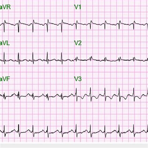 EKG On Admission Showing Sinus Tachycardia With A Ventricular Rate Of