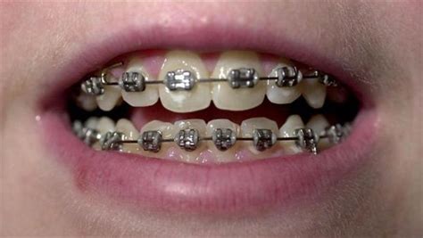 Dentaltown Why Are So Many Adults Having Braces Put On Their Teeth
