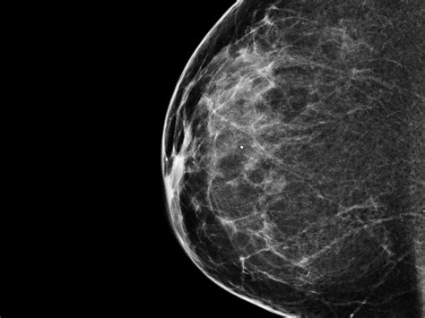 When You Need A Mammogram Should You Get One In 3 D Ncpr News