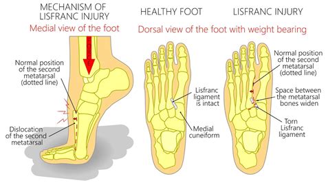 What Is A Lisfranc Injury And How Does It Happen