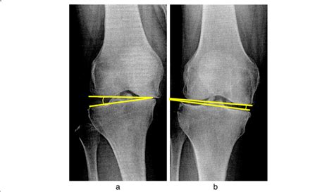 Varus And Valgus Stress Angle A Varus And B Valgus Stress Were Download Scientific Diagram