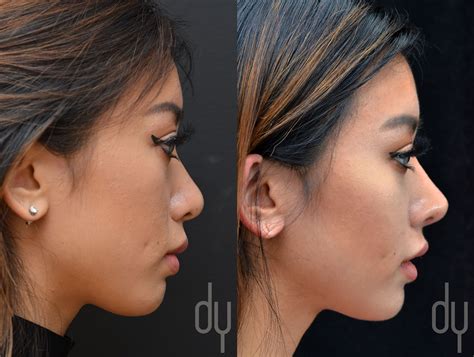 Before And After Revision Asian Rhinoplasty With Rib Cartilage And DCF Diced Cartila Facial
