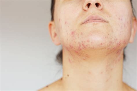 Chin Acne Causes Painful Hormonal Around Under Chin And Treatments