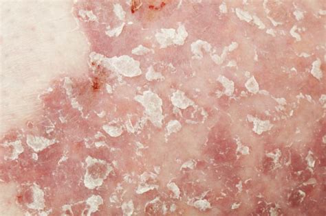 Study Links Psoriasis With Blood Vessel Inflammation
