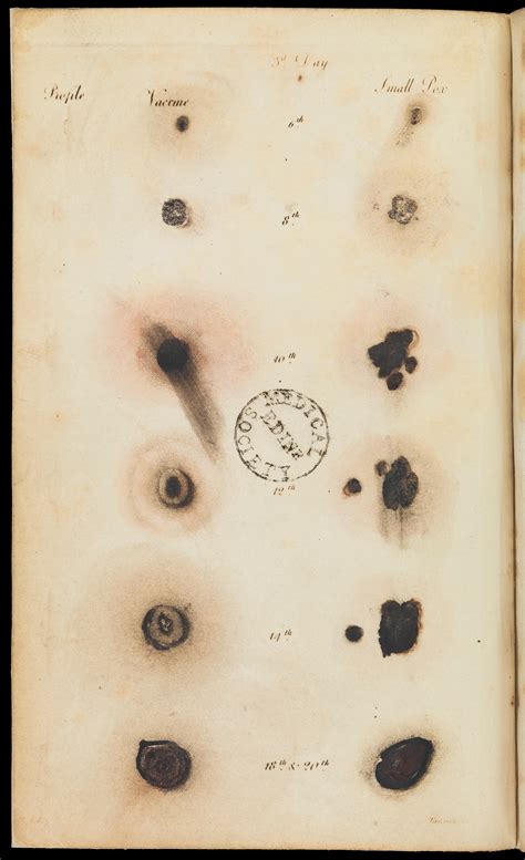 Comparative View Of Vaccine And Small Pox Stages Wellcome Collection