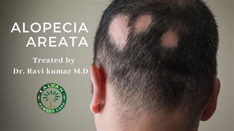 Sudden fall out of a handful of hair while combing or washing hair transplantation: Alopecia Areata Treatment | Hair Loss in Patches| Dr.Ravi ...