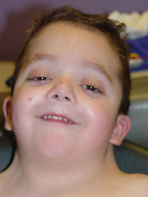 Noonan Syndrome Causes Symptoms Diagnoses Treatment Pictures The Best