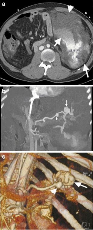Ruptured Splenic Artery Aneurysm A Axial Contrast Enhanced Ct Of A