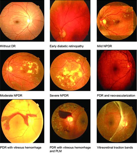 Stages Of Diabetic Retinopathy Download Scientific Diagram