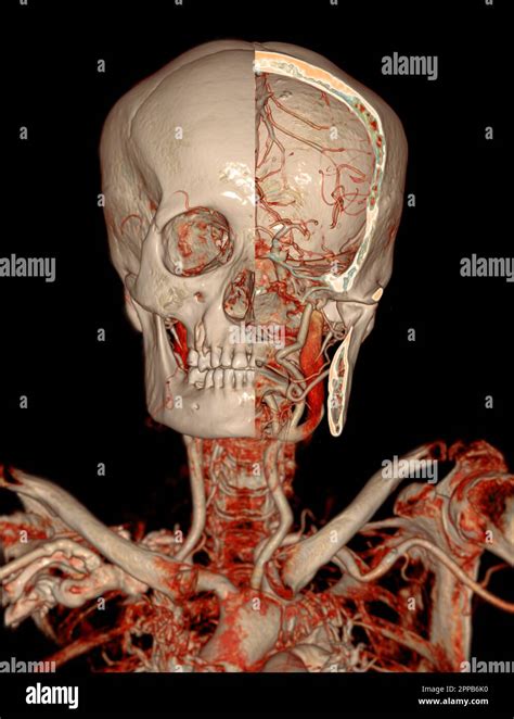 Cta Brain And Carotid Artery Or Ct Angiography Of The Brain 3d