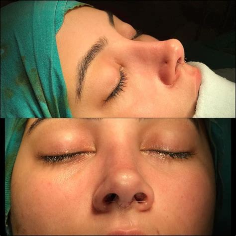 Unlike a breast augmentation or facelift, nose surgery involves altering the physical shape of a body part which you depend on every day for. #rhinoplastik #burunnose #nasenjob #knopf #nase # ...