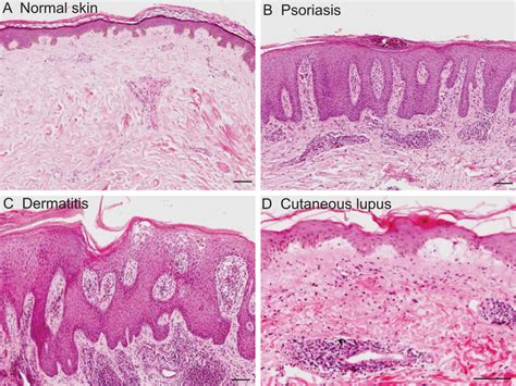 Normal Skin Psoriasis Atopic Dermatitis And Cutaneous Lupus Tissue