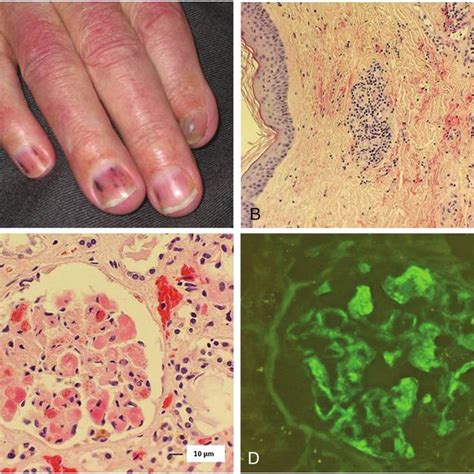 Cryoglobulinaemic Vasculitis Manifested As Skin Lesions And Renal