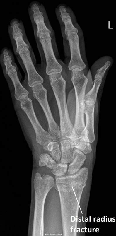 Distal Radial Fractures | Dr Paul Jarrett, Hand, Wrist & Shoulder Surgeon.