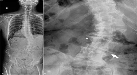 The Relationship Between Lumbar Lateral Listhesis And Radicu Spine