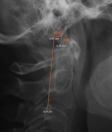 Cervical Spine Radiographic Anatomy Radiologypicscom