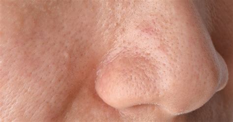 Sebaceous Filaments About Vs Blackheads Why To Leave Alone