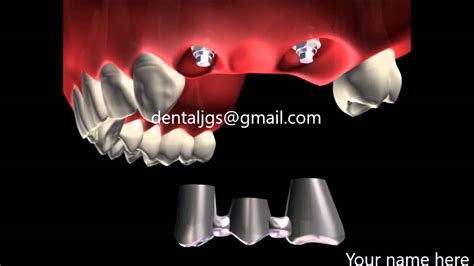 Dental Software Fixed Partial Denture Screwed On Implant Class
