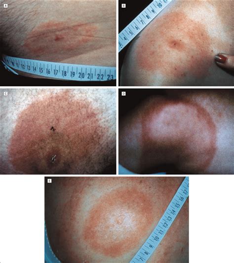 Solitary Erythema Migrans In Georgia And South Carolina Dermatology