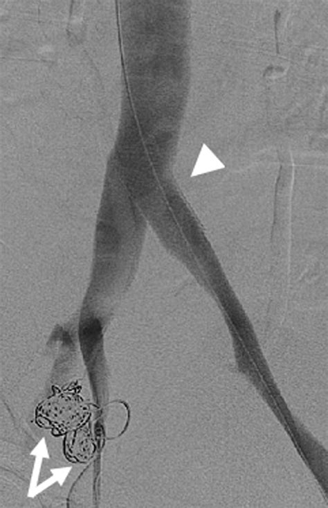 Completion Venogram Showing Complete Thrombosis Of The Venous Aneurysms