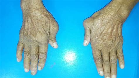 Rheumatoid Arthritis Hand Deformities Youtube