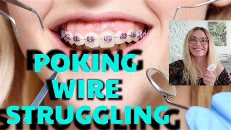 Struggling With Poking Wire My Adult Braces Journey Making Space With Coil Springs For