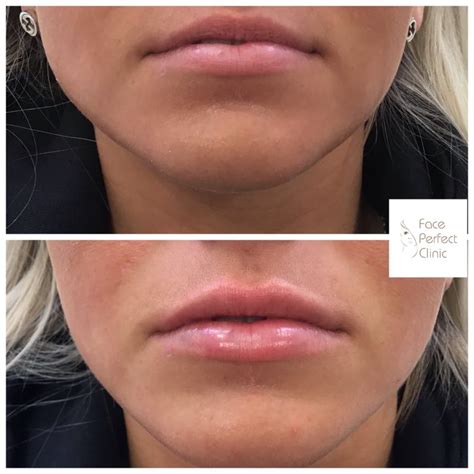 Dermal Lip Fillers Leeds Lip Augmentation Face Perfect Clinic