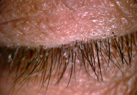 Crab Lice Infestation In Unilateral Eyelashes And Adjacent Eyelids A