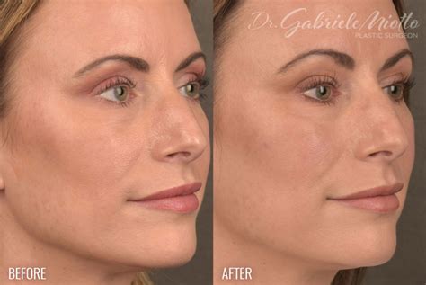 Facial Fat Grafting Before And After Photos Me Plastic Surgery