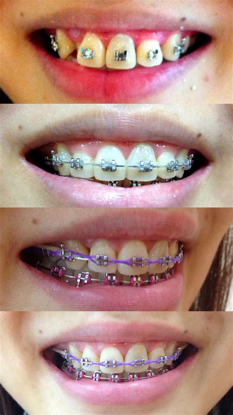 Braces Smile Dental Braces Braces Colors Orthodontics Braces