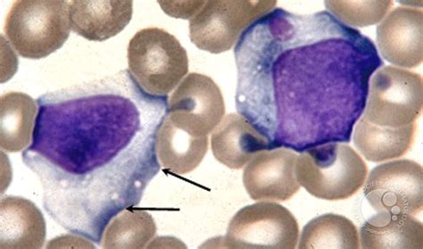 Infectious Mononucleosis And Atypical Lymphocytosis On A Smear