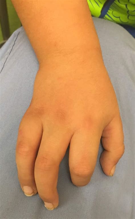 Unusual Extra Finger Congenital Hand And Arm Differences Washington University In St Louis