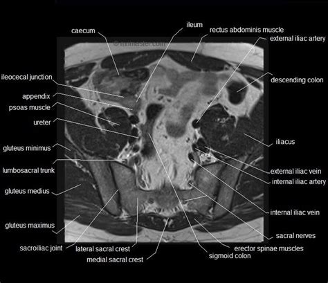 Mri anatomy and positioning series module 5: 28 best MRI MALE PELVIS images on Pinterest | Pelvis ...