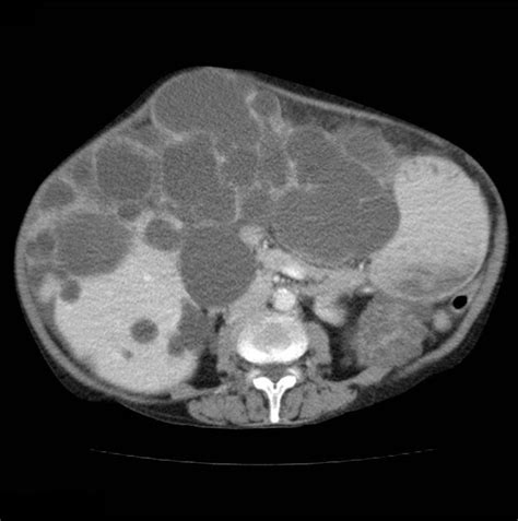 Autosomal Dominant Polycystic Kidney Disease Radiology Case