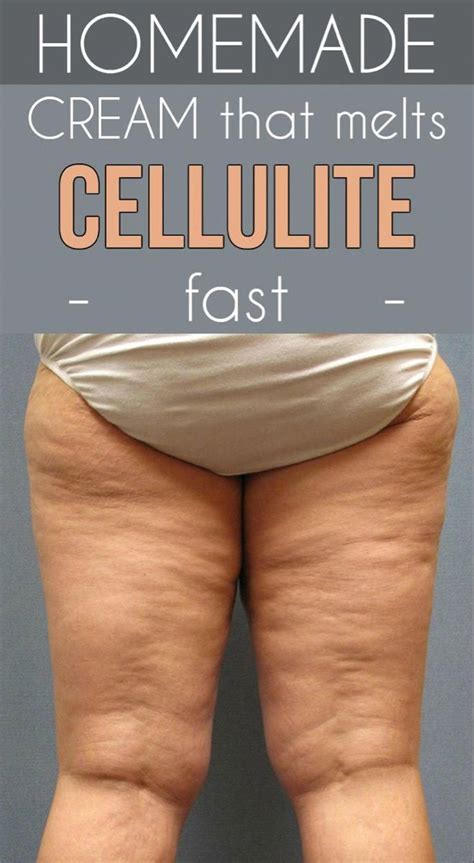 pin on quick cellulite removal