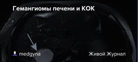 Гемангиомы печени диета Гемангиомы печени и КОК: medgyna — LiveJournal Гемангиомы печени и КОК: medgyna — LiveJournal Гемангиомы печени диета