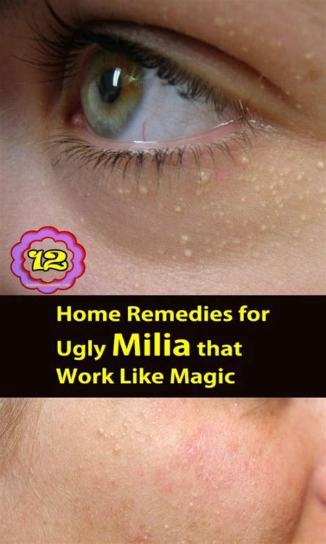 They do not usually cause pain, itching, or irritation, but they usually cause. Milia also called milk spot on skin, these tiny facial ...