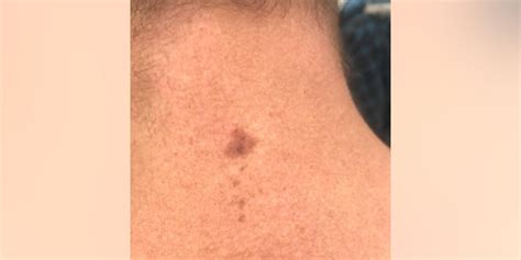 Pictures Of Skin Cancer On Back Of Neck Picturemeta