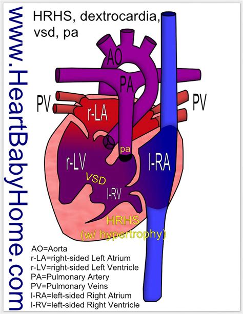 74 Hypoplastic Right Heart Syndrome With Dextrocardia V Flickr