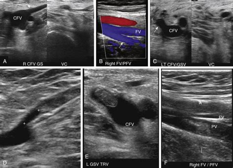 Ultrasound Diagnosis Of Lower Extremity Venous Thrombosis Radiology Key