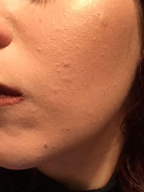 Small Bumps On Cheeks Beauty Insider Community