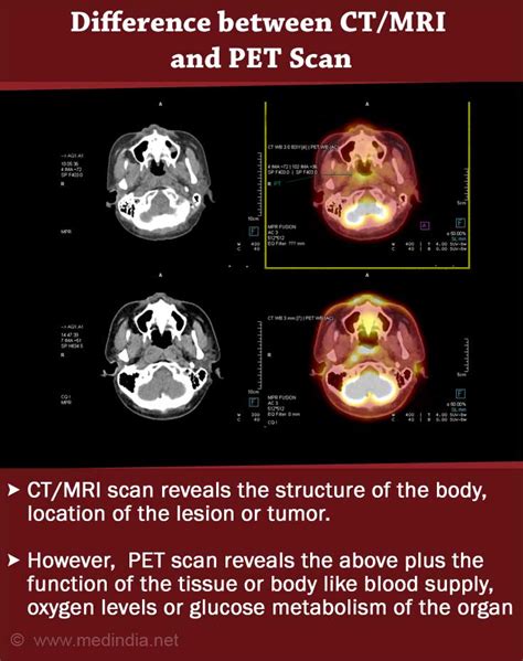 Positron Emission Tomography Pet Scan Procedures Types Risks