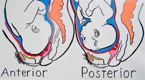 Posterior Baby Position And What To Do About It