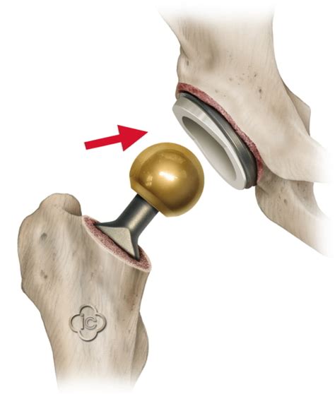 Total Hip Replacement Surgery Hip Prosthesis Joint