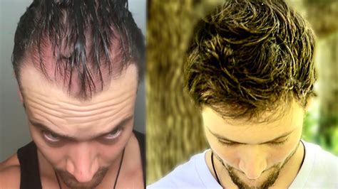 You can't always prevent hair loss in men, but you can learn more about how to reduce or prevent hair loss. How I Quit The World's Best Hair Loss Treatment and Regrew ...